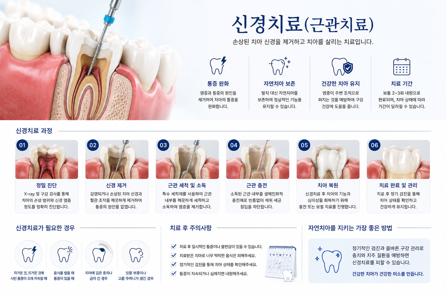봉담 신경치료 근관치료 과정 설명 이미지 — 감염된 치수 제거와 근관 충전