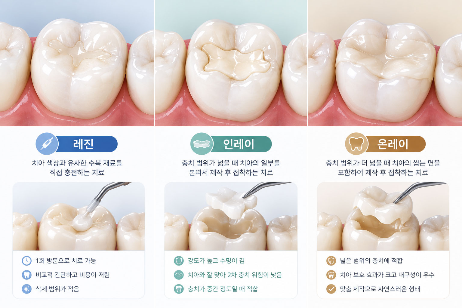 봉담 충치치료 레진 인레이 온레이 차이 설명 이미지